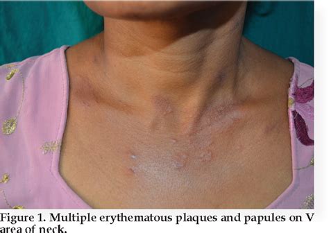Figure 1 From Photodistributed Acute Febrile Neutrophilic Dermatosis A