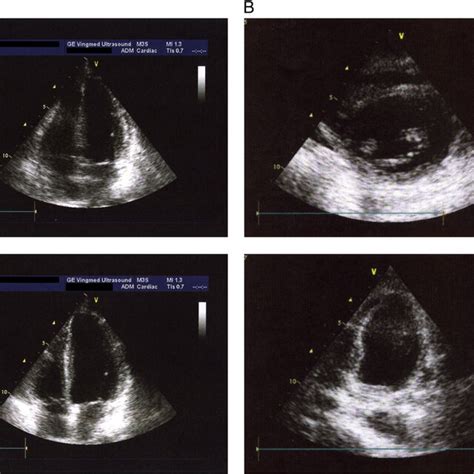 A Normal Tte At The Time Of Admission B Image Of Tcm In The Tte 1 Download Scientific