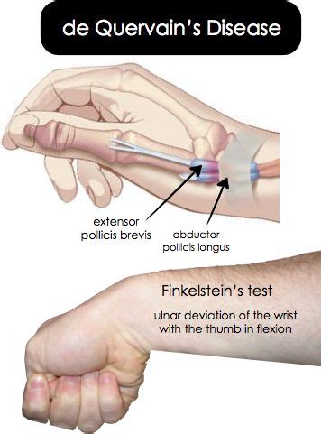 The finkelstein test is performed by having the patient make a fist with the thumb inside the fingers. Pin on ORTHOP