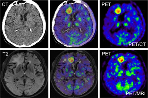 Mri Pet Ct 違い