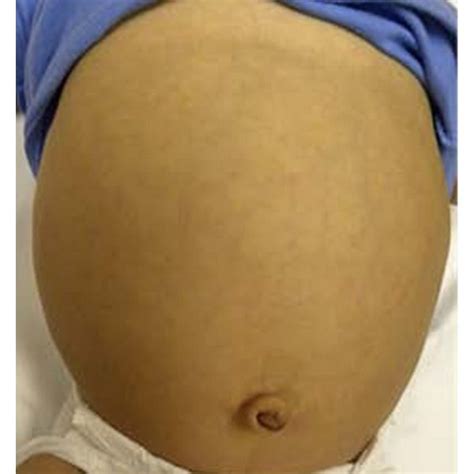 Protuberant Abdomen And A Small Umbilical Hernia Download Scientific