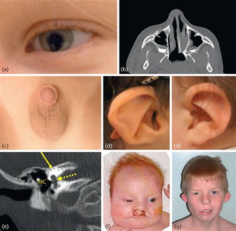 CHARGE syndrome causes, symptoms, diagnosis, life expectancy & treatment