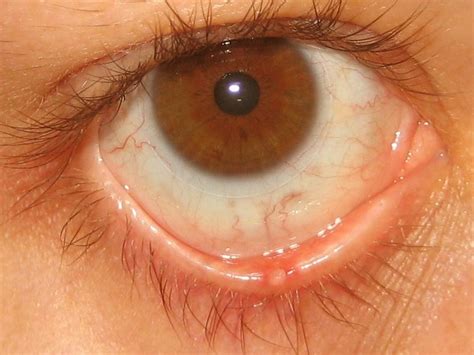 Stye Pictures Contagious Symptoms Causes Treatment