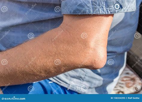 Inflamed Bursa On The Elbow Of A Man Stock Image Image Of Retention