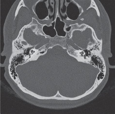 The Control Axial Ct Scan Through The Right Side Temporal Bone Shows