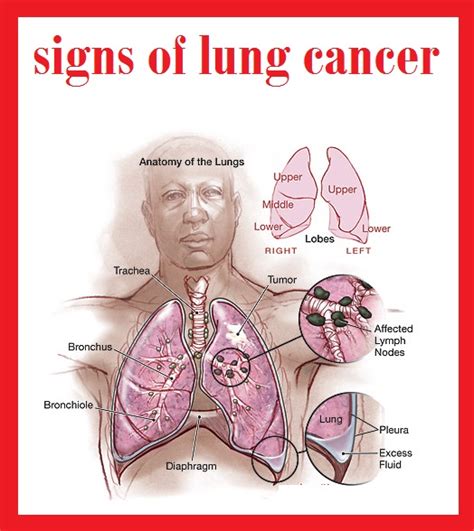 about lung cancer 3000 signs of lung cancer