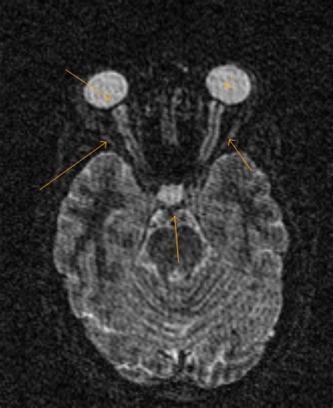 Idiopathic Intracranial Hypertension Mri Sumers Radiology Blog
