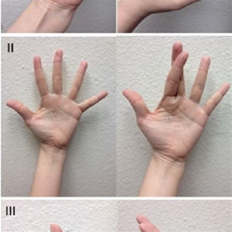 Motor Examination Of The Hand I Median Nerve Ii Ulnar Nerve Iii Porn