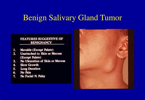 Ppt Malignant Salivary Gland Tumors Powerpoint Presentation Free My