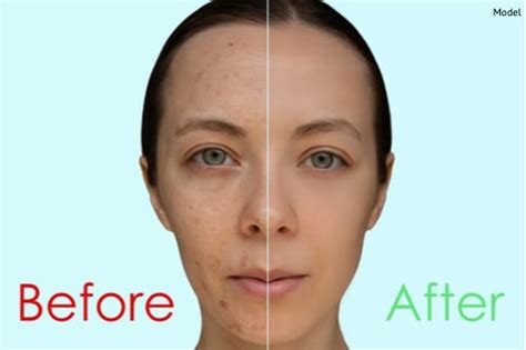 What Can Chemical Peels Do For Acne And Acne Scars Cohaitungchi Tech