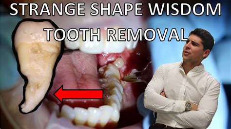Lower Partially Erupted Wisdom Tooth Removal Full Procedure Of