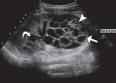 Kidney Tumor Ultrasound