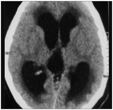 Hydrocephalus On Ct Scan