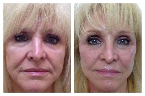 Liquid Facelift Liquid Facelift Neck Lift Facelift Before And After