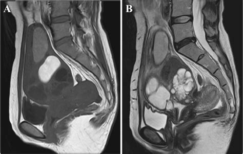 Magnetic Resonance Imaging Mri Of The Pyogenic Cervical Cyst A A