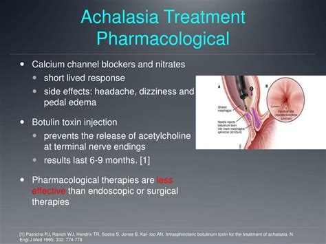 Esophageal Achalasia Treatment