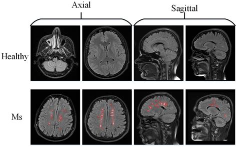 Multiple Sclerosis Vs Normal Brain Mri Hot Sex Picture