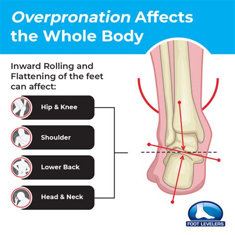 Overpronation Causes Treatment And Exercises Peacecommissionkdsg