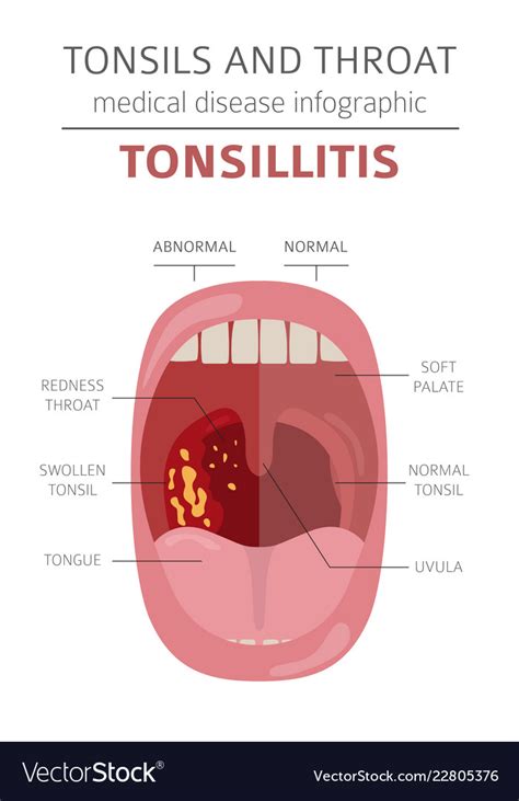 Tonsils And Throat Diseases Tonsillitis Symptoms Vector Image Sexiz Pix
