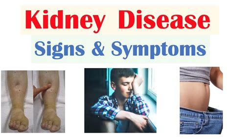 What Are The Symptoms Of Kidney Disease Fitpaa