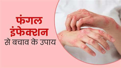 फंगल इंफेक्शन दूर करने के लिए घरेलू उपाय Home Remedies To Cure Fungal