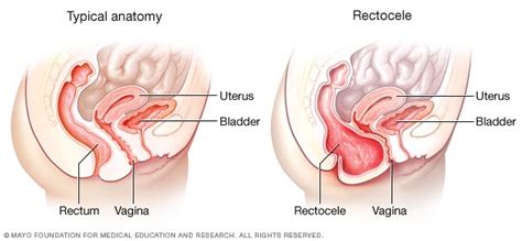 Posterior Vaginal Prolapse Rectocele Beacon Health System