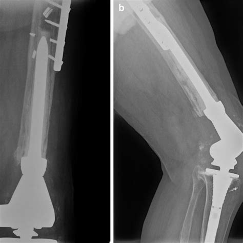 A Distal Femur Replacement With Pre Existing Cemented Modular Femoral