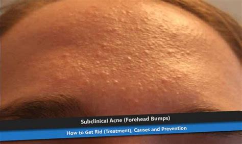 Get Rid Of Bumps On Forehead Get Rid Of Bumps