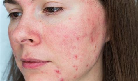 Acne Rosacea Whats The Difference Between Acne And Acne Rosacea