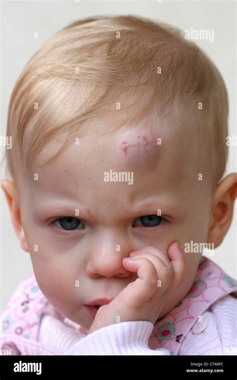 Child With Hematoma Stock Photo Alamy