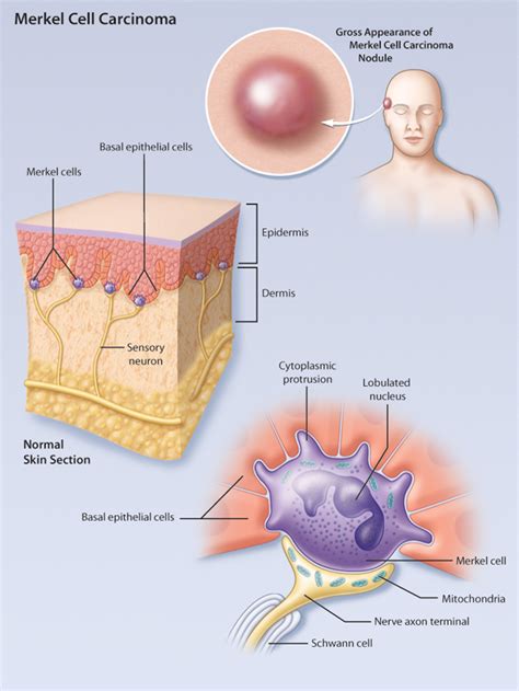 The first symptom of this type of cancer is normally a very fast growing nodule or tumor that is painless and is. Merkel Cell Carcinoma: A Case Report and Brief Review of ...