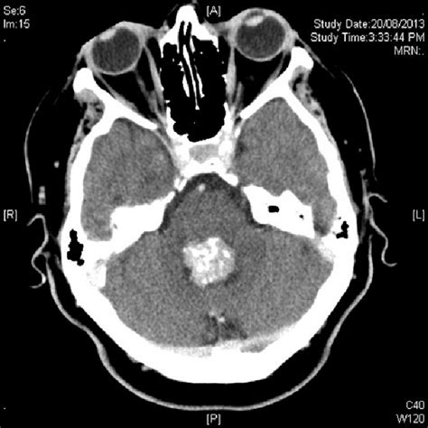 Axial Contrast Enhanced Ct Showing Hyperdense Rounded Lesion In Fourth