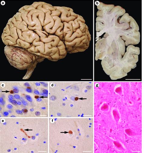 Neuropathology Of The Patients Brain A Mild Atrophy Of The
