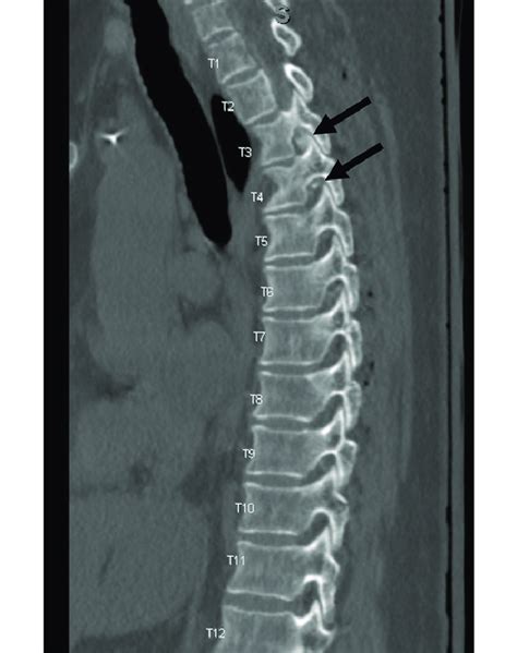 Sagittal Contrast Enhanced Ct Myelogram Of The Thoracic Spine
