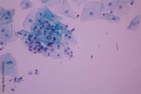 View In Microscopic Of Candidiasis Fungus Infection Yeast And