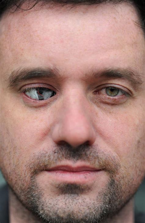 Rob Spence Bionic Eye Toronto Filmmaker Replaces Eyeball With Camera Au — Australia
