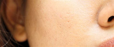 Large Pores Treatments In Victoria Bc Rosenthal Clinic