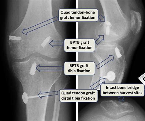 Combined Reconstruction Of The Medial Collateral Ligament And Anterior