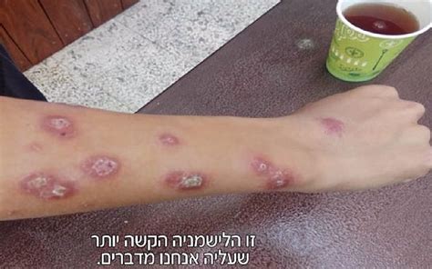 Disease Spreading Flies Torment West Bank Northern Israel The Times