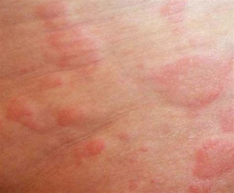 Itching Skin Rash Pictures Photos