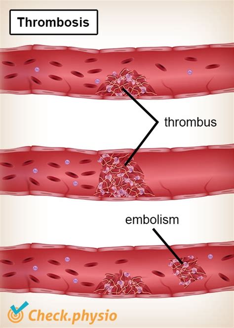 Leg Thrombosis Physio Check