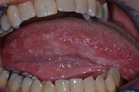 Idiopathic Leukoplakia