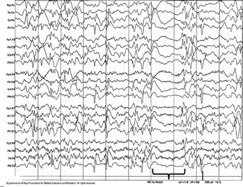 Figure 75 Hypsarrhythmic Eeg Pattern In An