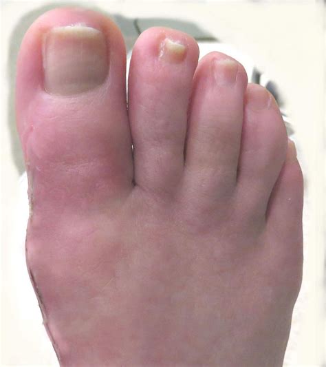 West Vancouver Foot Clinic Hammertoe And Bunion Surgical Procedures
