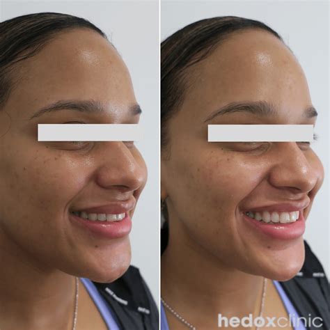 Weak Chin Treatment London Jawline Fillers Hedox Clinic