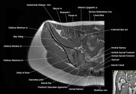 Pelvis Muscles Mri Anatomy Normal And Variant Pelvic Anatomy On Mri Radiology Key Muscles Of