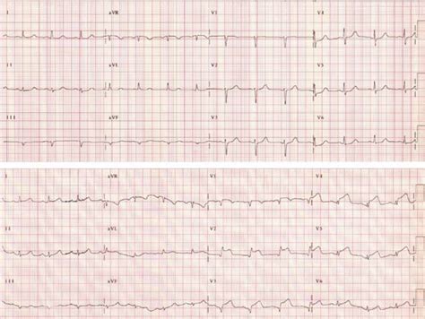 A ECG On Admission Shows An Old Inferior Myocardial Infarction