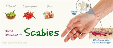 Dont Skip This Article If You Are Suffering From Scabies Best All