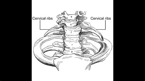Cervical Ribs Anatomy An Extra Rib Anomaly And Its Copression Of Lower