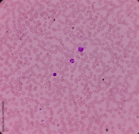 Microscopic Image Of Macrocytic Anaemia Folic Acid Deficiency Vitamin B12 Deficiency